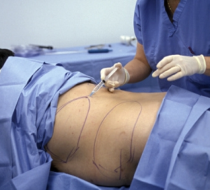 Read more about the article Liposuction – A Solution To Cellulite Problems