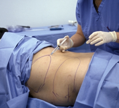 You are currently viewing Liposuction – A Solution To Cellulite Problems