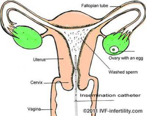 Read more about the article Why UK Patients Should Consider Spain for IVF and Artificial Insemination