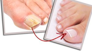 Read more about the article Why toenail infections happens and how you can do the treatment?