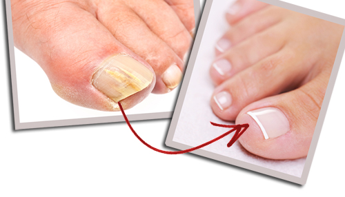 You are currently viewing Why toenail infections happens and how you can do the treatment?