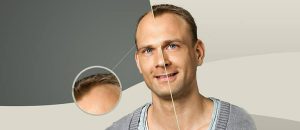 Read more about the article What to Expect From a hair implants procedure?