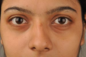 Read more about the article 5 Ways To Cure Puffy Eyes Permanently