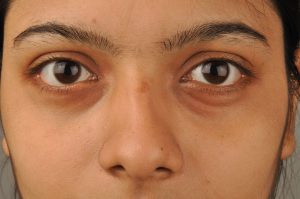 Read more about the article Do Home Remedies Work For Dark Circle Under The Eyes?