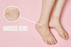 Read more about the article Spider Veins vs Varicose Veins: What’s the Difference?