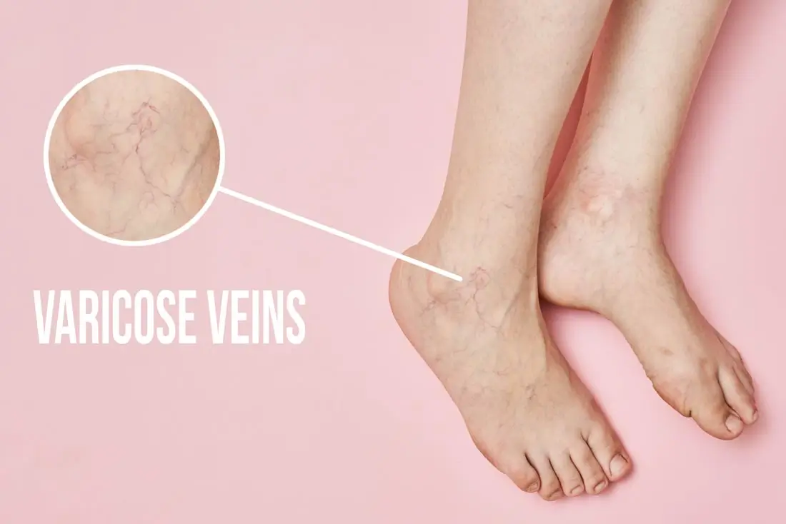 You are currently viewing Spider Veins vs Varicose Veins: What’s the Difference?