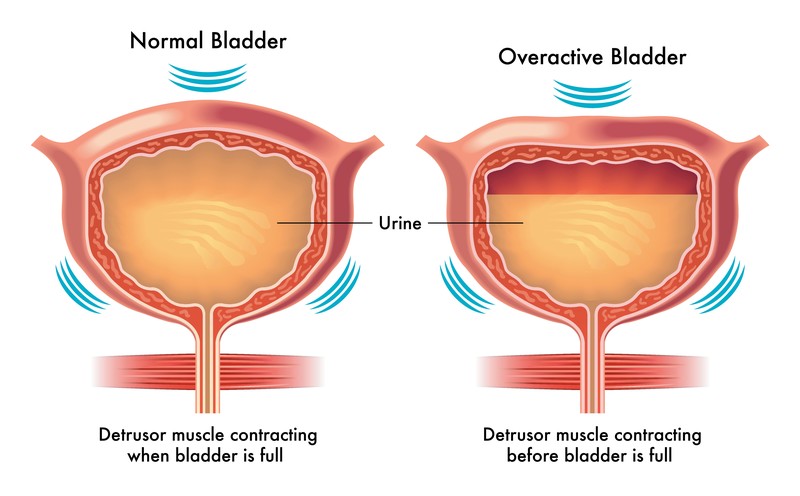 You are currently viewing How to Know About Overactive Bladder – Symptoms, And Causes