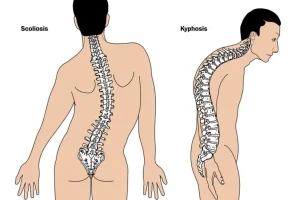 Read more about the article How to Avoid Long Term Spine Problems