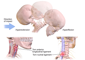 Read more about the article Why You Need to Recover from Whiplash