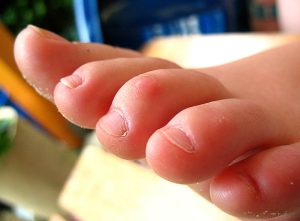 Read more about the article When Surgery for Hammertoe is the Best Option?