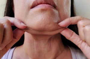 Read more about the article How Loose Skin Removal Can Boost Confidence and Improve Appearance