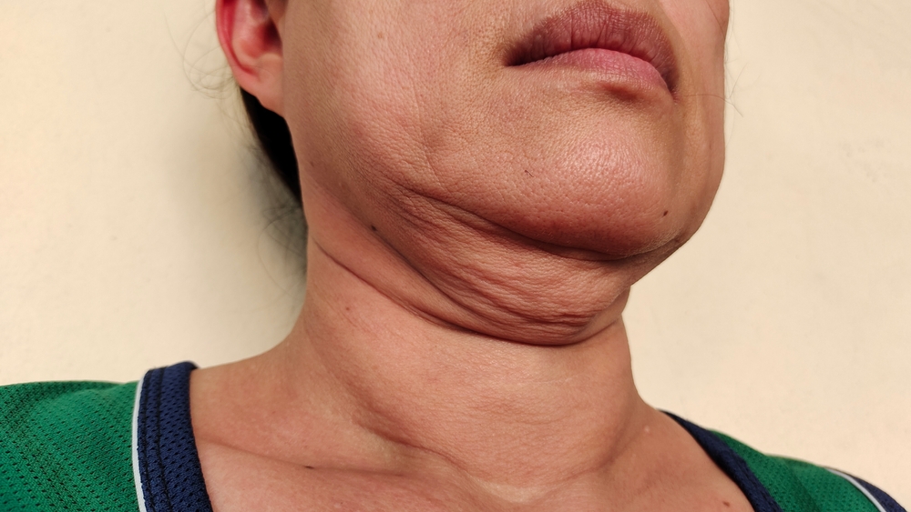 loose skin removal hawthorn 